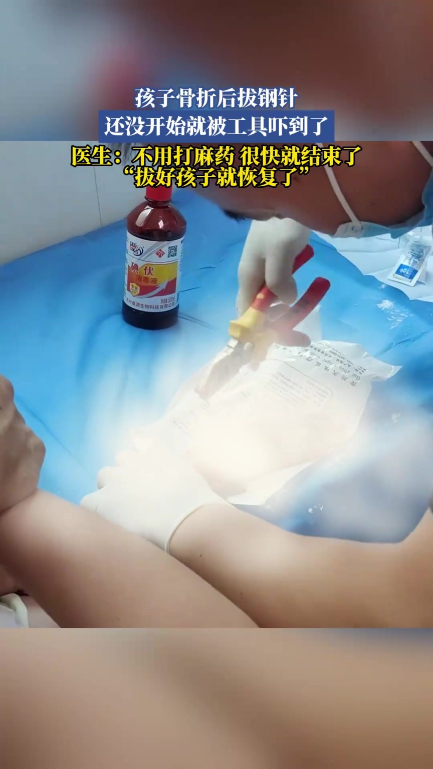 孩子骨折后拔钢针，还没开始就被工具吓到了