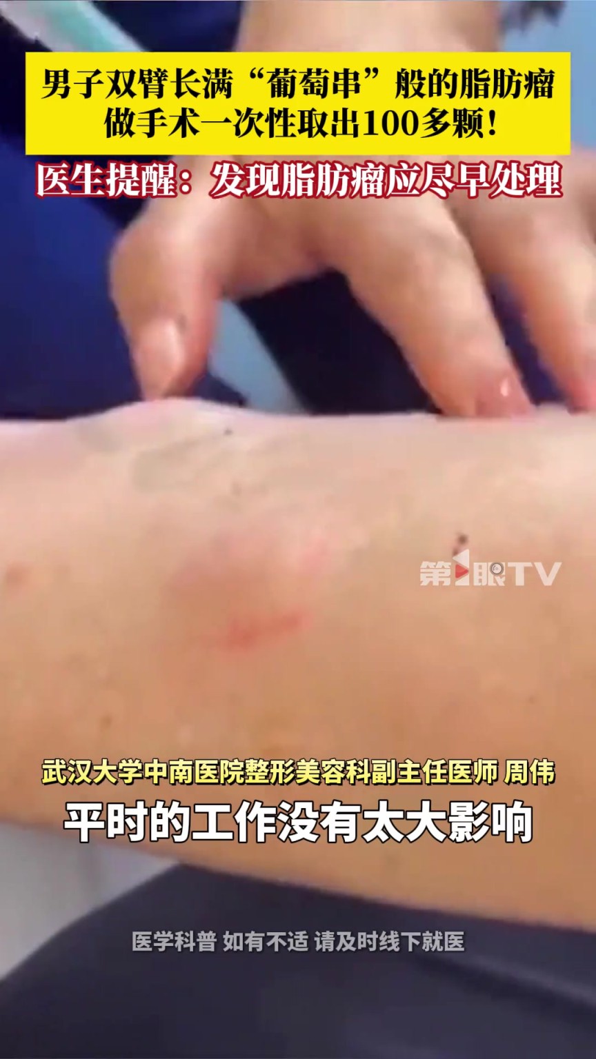 男子双臂长满“葡萄串”一般的脂肪瘤，夏天穿短袖露胳膊很苦恼