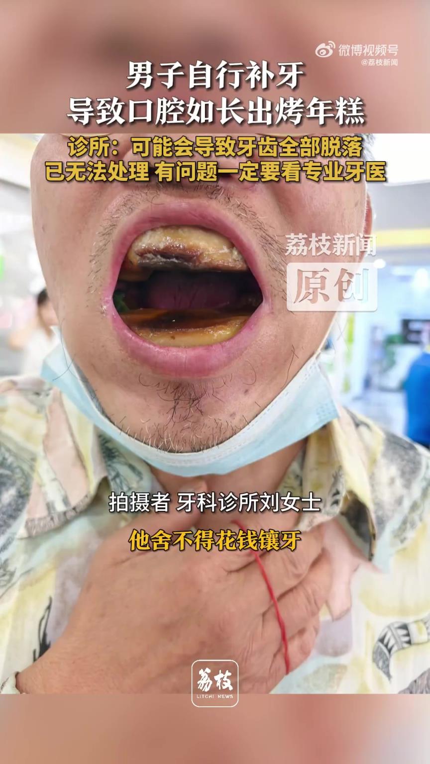 买5元树脂自行补牙致口腔变年糕
