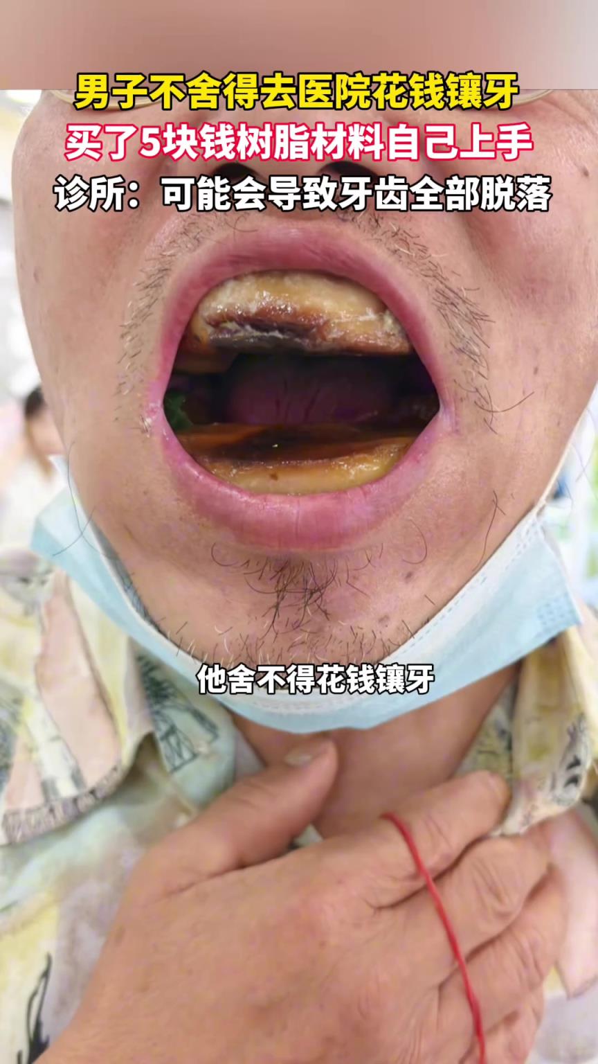 男子不舍得去医院花钱镶牙，买了5块钱树脂材料自己上手！
